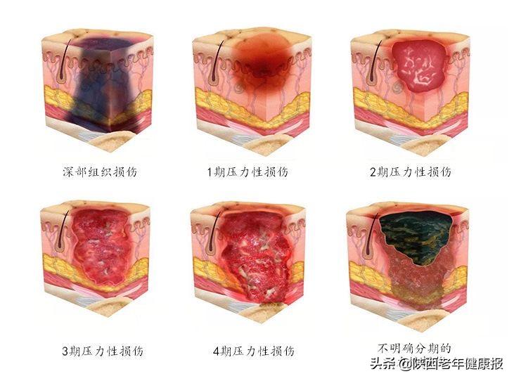 褥疮最新分期,褥疮分期新标准